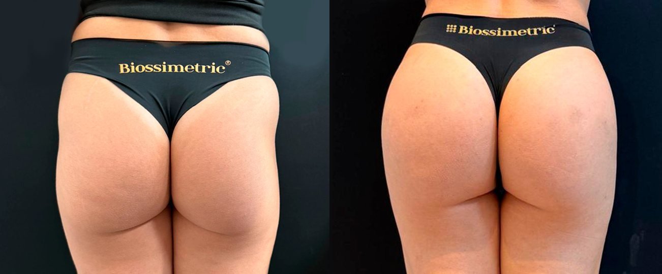 Antes e depois — harmonização glútea, caso 01